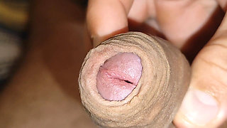 Amazing Dilator Vessel Has Disproportionate Increase.