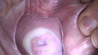 Insertion Semen in Cervix Pussy Speculum. Cum in Uterus