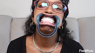 Youronlyphoenix Dental Retractor Mouth Tour
